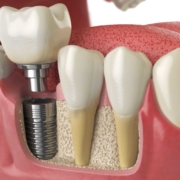 allow dental implants
