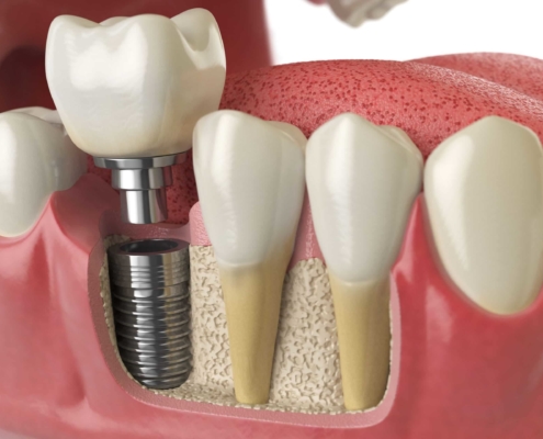 allow dental implants