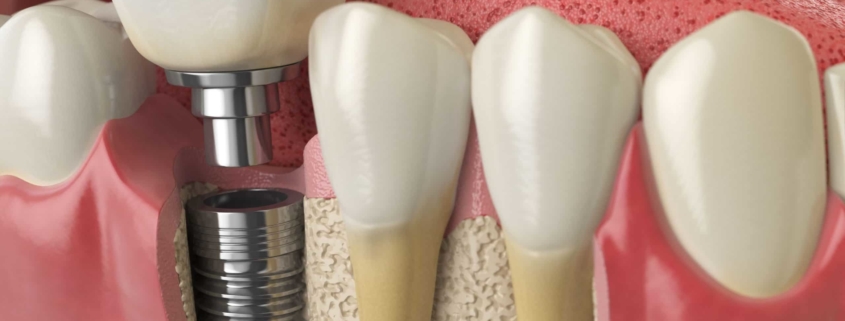 allow dental implants